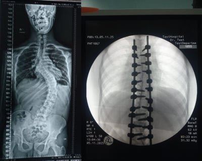 إنجاز طبي في مستشفى الأمير حمزة: تصحيح جنف حاد بالعمود الفقري